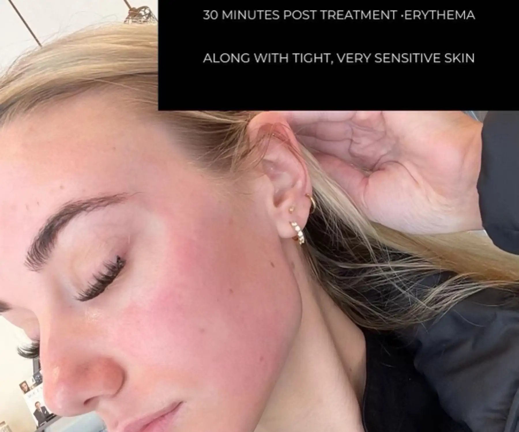 30 minutes after chemical peel treatment showing sensitive, tight skin with erythema in Provo, Utah.