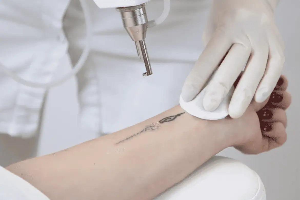 Close-up of specialist using a laser to remove a tattoo from a client’s wrist in Provo, Utah
