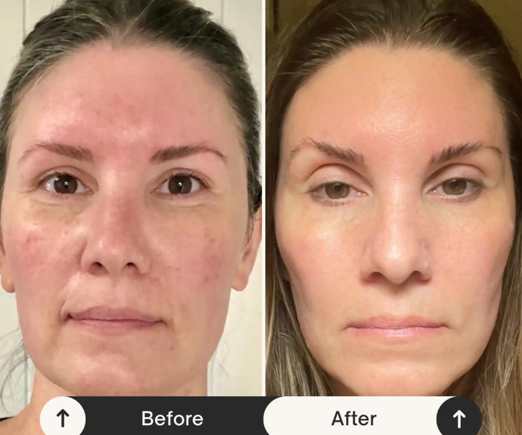 Side-by-side comparison showing skin improvement results before and after treatment in Provo, UT.