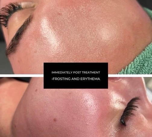 Before and after results of showing the immediate results of chemical peel treatment in Provo, UT.