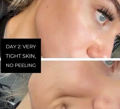 Progress photo on Day 2 of a chemical peel in Provo, UT, with very tight skin and no peeling yet.