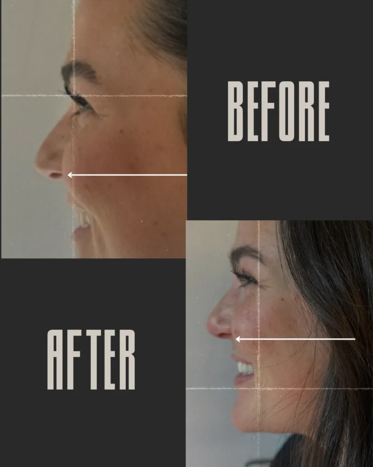 Before and after photo of filler treatment showing an improved side profile, with a straighter nose and reduced upper lip protrusion in Provo, UT.