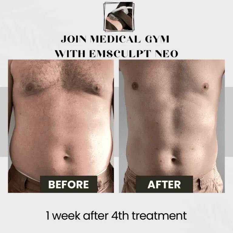 Before and after results of Emsculpt Neo treatment for a male, showing abdominal muscle toning after four sessions in Powell, UT.