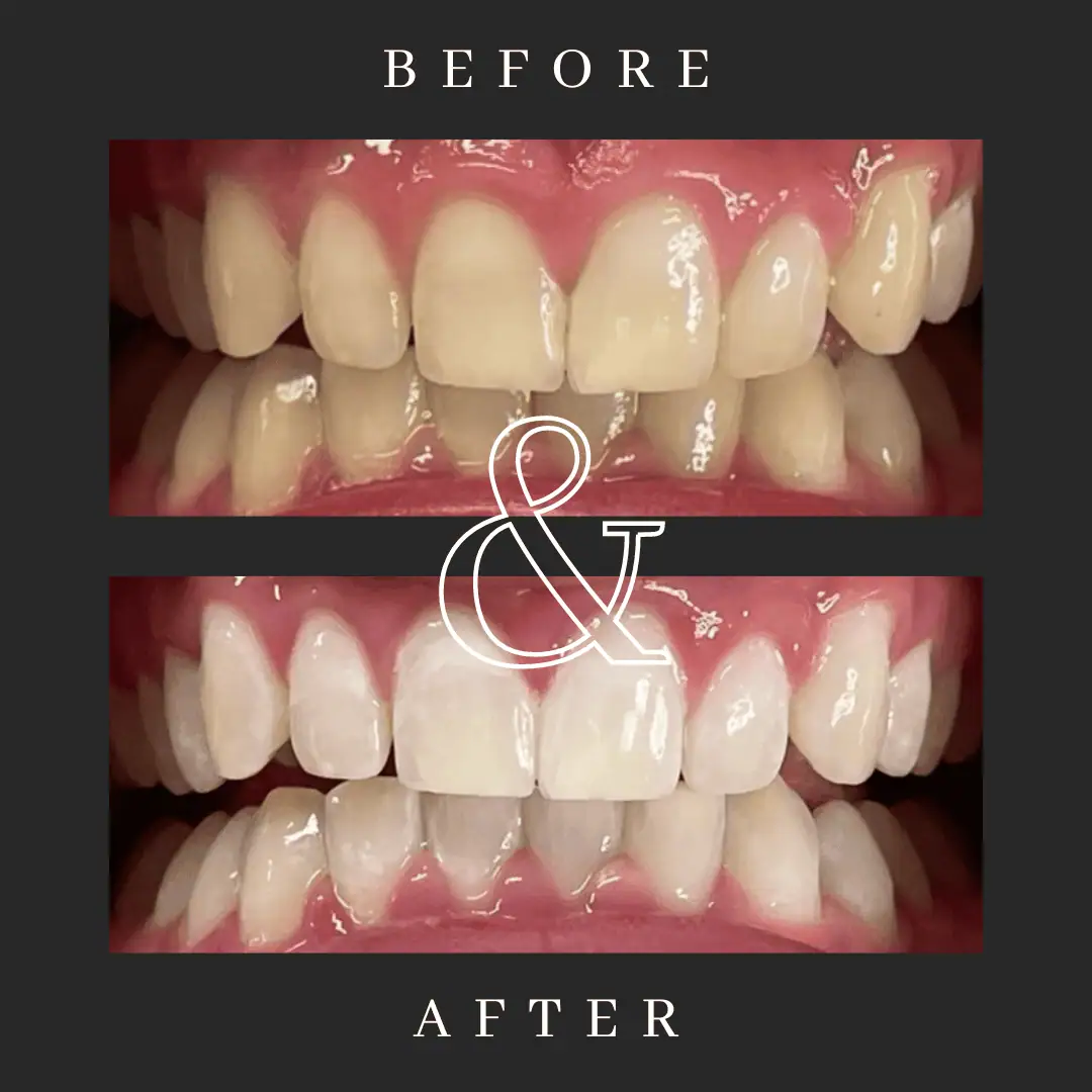 Before and after results of a teeth whitening treatment in Provo, UT.