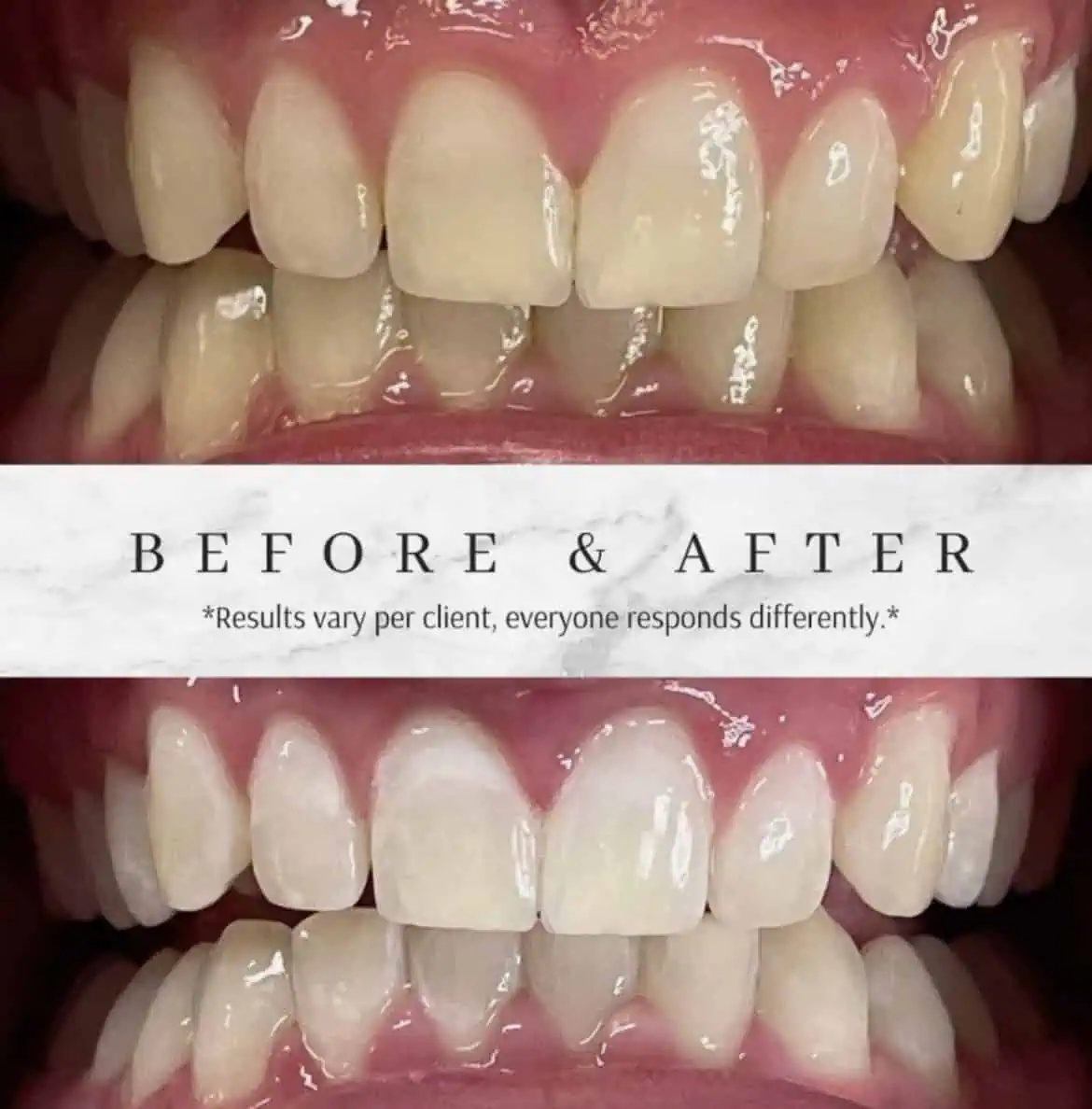 Before and after results of a teeth whitening treatment in Provo, UT.