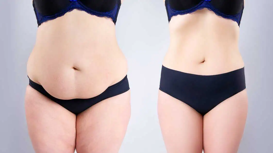 Before and after results of EmSculpt Neo treatment for body contouring and muscle toning in Provo, UT.