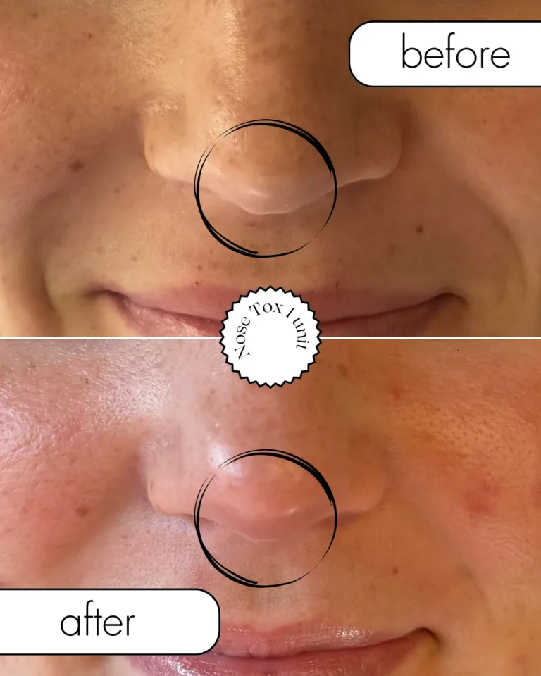 Before and after results of a Nose-Tox treatment, showing a subtly lifted nose tip and improved upper lip position in Provo, UT.