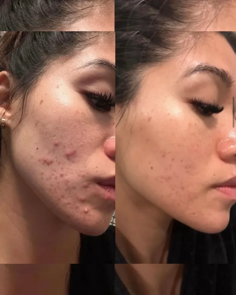 Before and after results of a Derma-Peel treatment, showing improved skin tone and clear, acne free skin in Provo, UT.