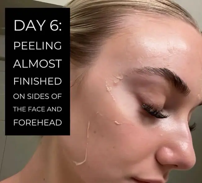 Progress photo on Day 6 of a chemical peel in Provo, UT, showing peeling on the sides of the face and forehead.