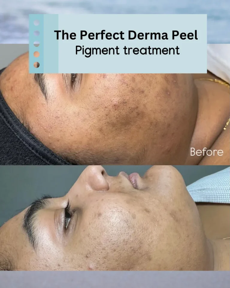 Before and after results of a Derma Peel pigment treatment for hyperpigmentation in Provo, UT.